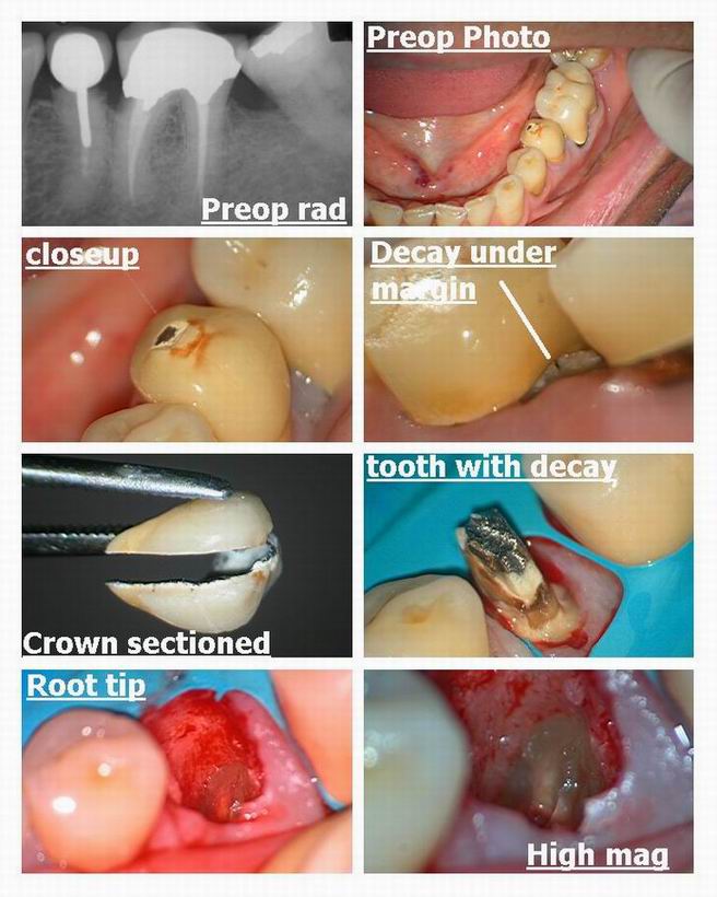 Resize of Resize of Osseous recontouring with bridge pt 1.jpg